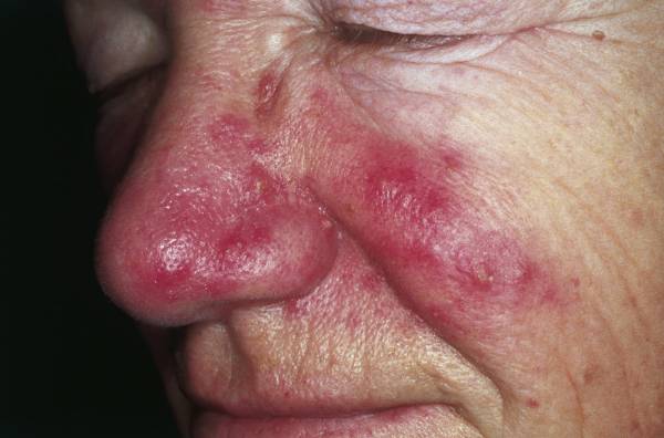 Osoba która ma rosacea